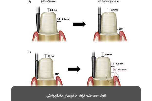 انواع خط ختم تراش با فرزهای دندانپزشکی