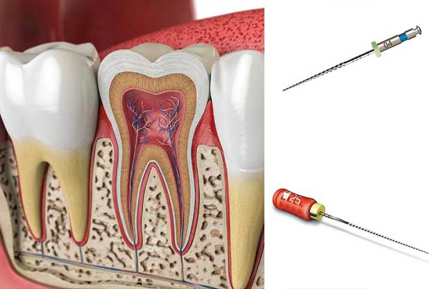 باربروچ دندانپزشکی چیست