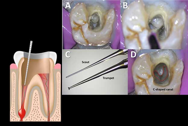 ضدعفونی کننده کانال دندان