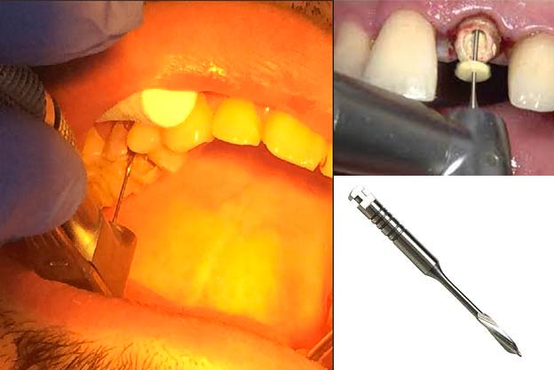 پیزو ریمر دندانپزشکی